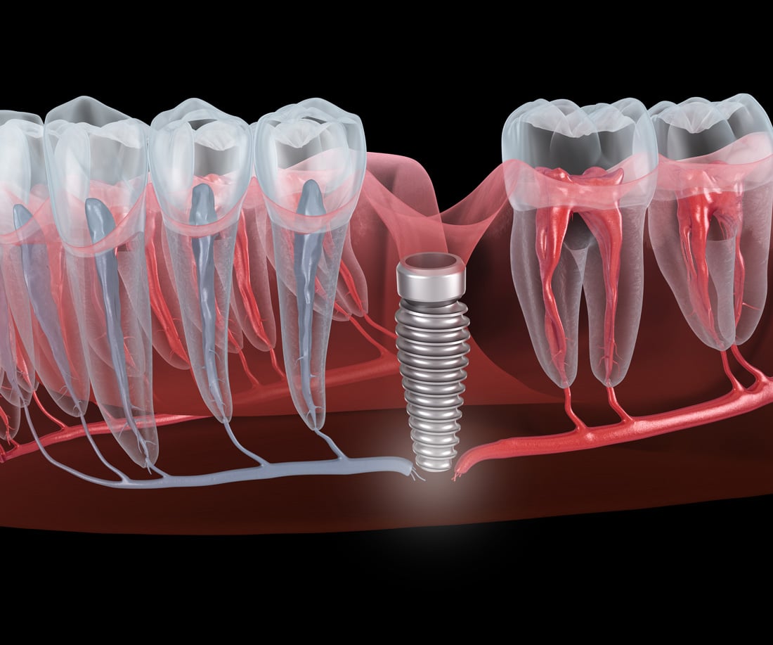 When Are Dental Implants Medically Necessary?