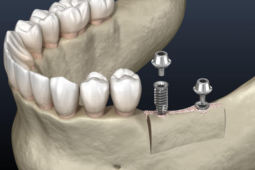 Can You Get Dental Implants With Bone Loss?