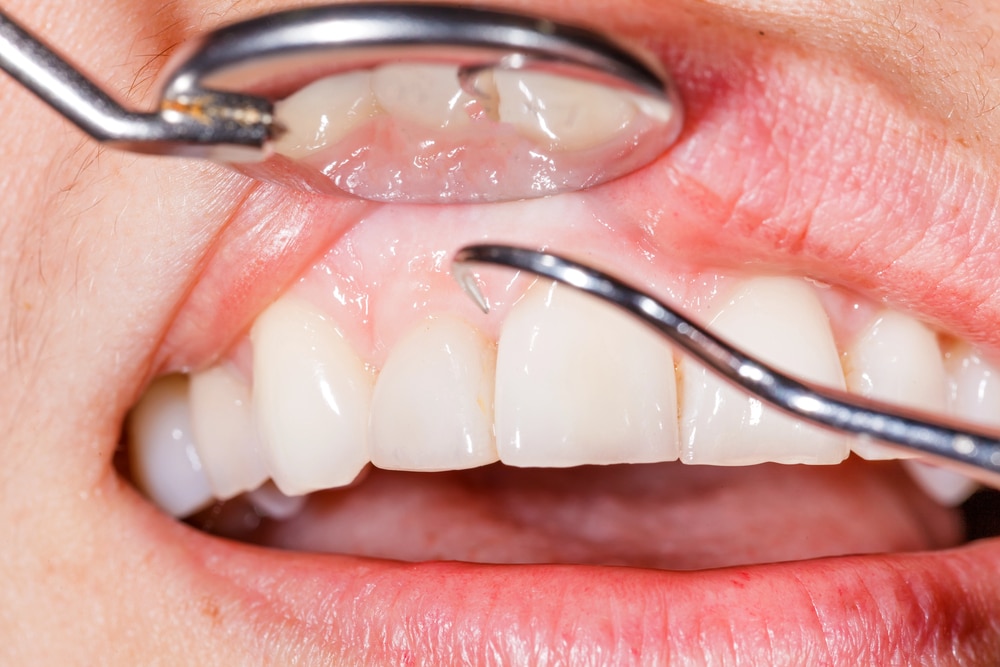 Can You Get Dental Implants With Gum Disease?